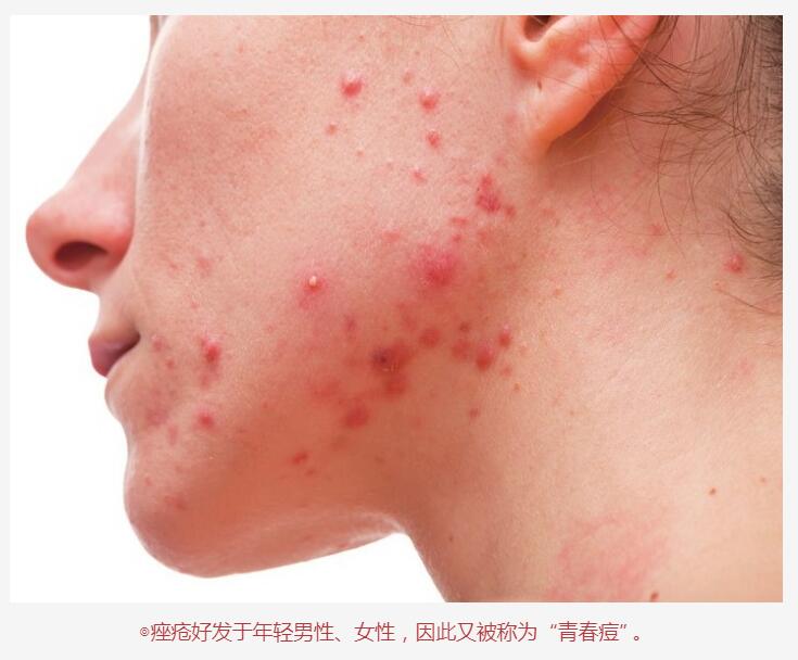 脸上的丘疹脓包是什么细菌,脸上的痘痘多是什么原因