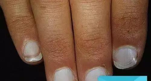指甲竖纹变少了,指甲竖纹发白没血色