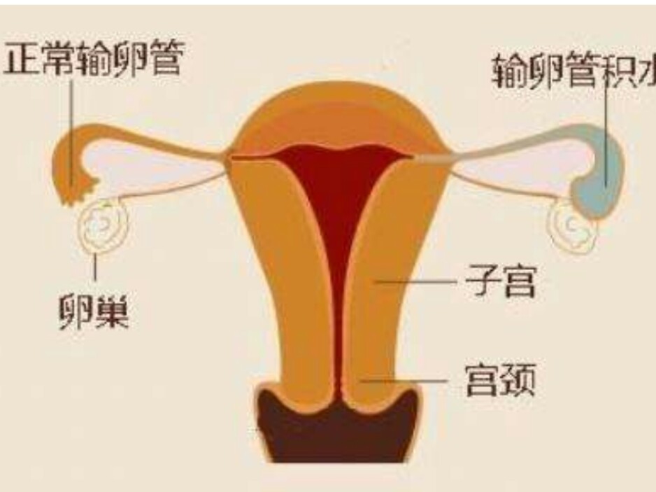 怎么改善让输卵管通畅,怎么让输卵管通畅