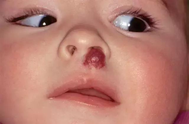 胎记及早治疗,胎记不治有什么后果