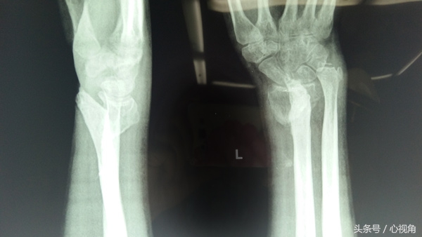 骨折后自行包中草药治疗,3个月后左腕部出现畸形