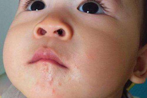 怎么预防宝宝过敏未出生,宝宝怎么预防皮肤病