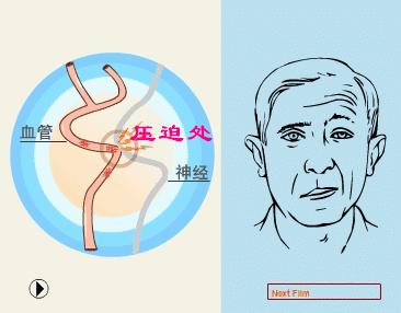 面瘫专家在线问诊,专家专治面瘫视频