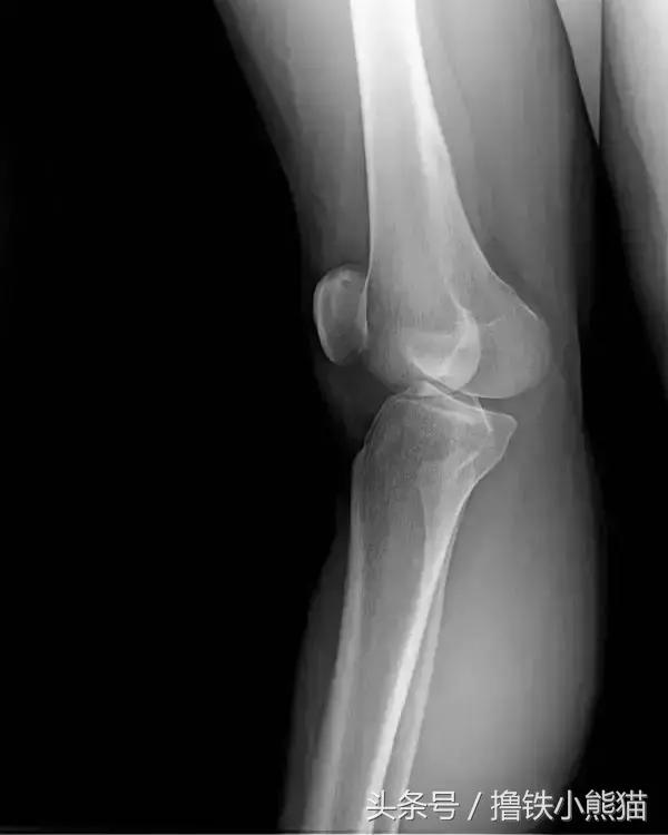 腿粗又有膝超伸该怎么改正,膝超伸为什么腿会粗