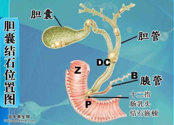 结石太大块体外碎石可以碎吗,得了结石用碎石可行吗