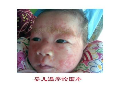 婴儿湿疹需要注意哪些事项,母乳喂养的宝宝得湿疹是什么原因