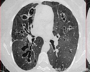 支气管扩张是大病吗,支气管扩张