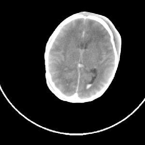 非创伤性颅内出血平时有哪些症状,新生儿颅内出血临床表现新闻案例