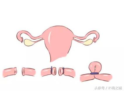 上环、取环究竟有多痛?没经历过的恐怕不会懂!