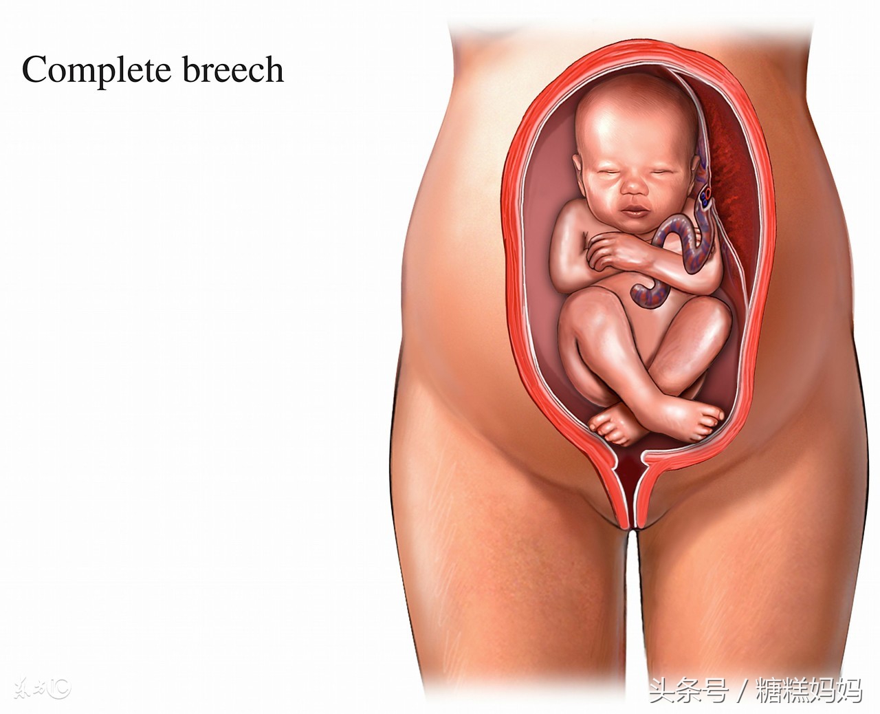臀位破水可怕吗怎么应对,臀位宝宝孕妈妈需要怎么应对