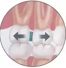 矫正牙齿明明不疼了又开始疼,矫正牙齿垫高咬合难受怎么办