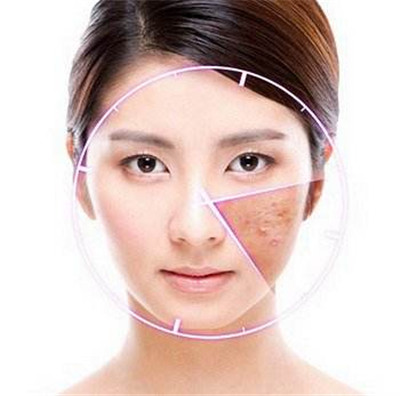 敏感油痘肌怎么去黑头闭口,你知道黑头痘肌怎么来的么