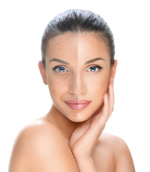 额头油脂堵塞如何处理,额头一直反复长油脂粒涂的药膏