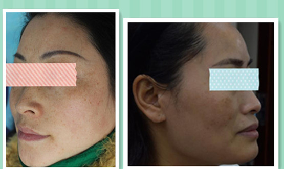 40多岁女性脸上斑多是怎么回事,40岁长斑的女性吃什么祛斑最好