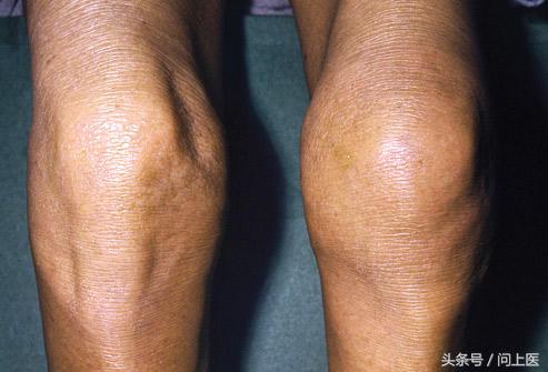 运动后膝盖疼痛的原因和解决方法,跑步后膝盖疼痛的原因和解决方法