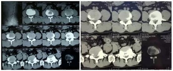 椎间盘突出症椎间孔镜术的概述,椎间孔镜治疗颈椎间盘突出过程