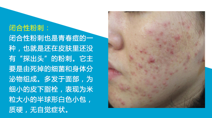 八种痘痘,九大部位的痘痘