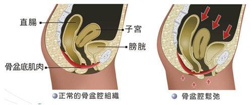 怀孕分娩对盆底肌肉的影响,生完孩子盆底肌受损严重可以恢复吗