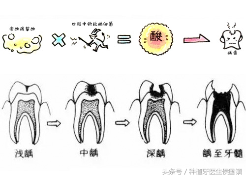 乳牙龋齿掉了只剩牙根了怎么办,儿童乳牙龋齿是拔掉还是根管治疗