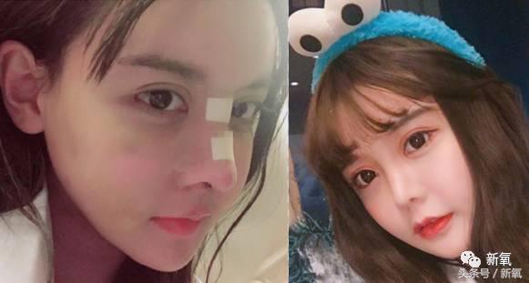 韩安冉这次鼻子修复是在哪修复的,韩安冉现在做的鼻子是什么款的