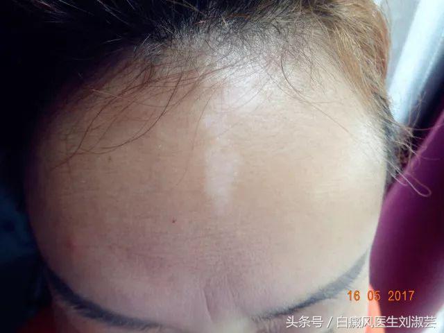 白斑病患者自述,白斑患者图片