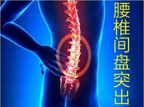 如何锻炼才能治好腰椎间盘突出,腰突锻炼方法腰椎间盘突出