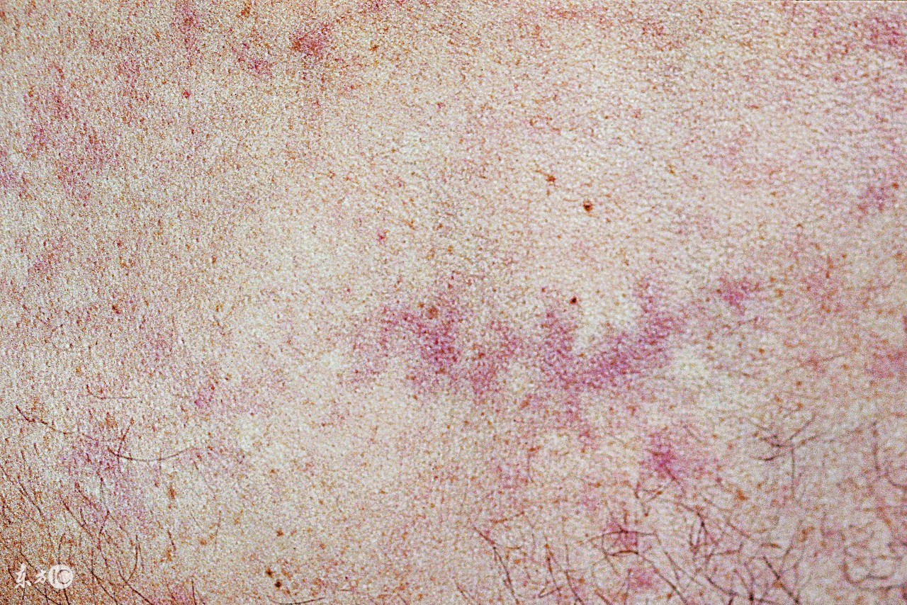 关注银翘病咨询,关注皮肤病