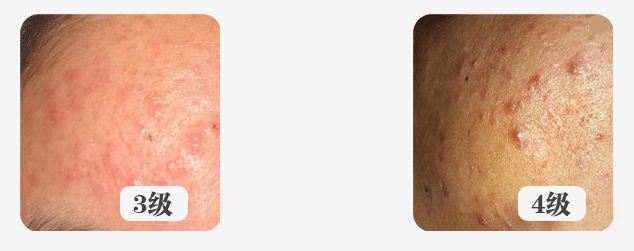 面部痘痘认知,痘痘的认知