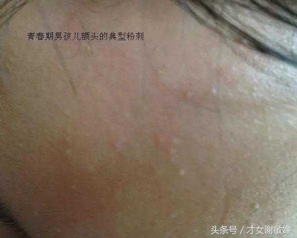 护肤处理闭合粉刺,谢敏婵的护肤品