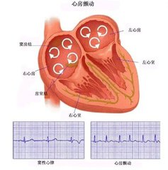 房颤患者是保守治疗还是积极治疗,房颤最主要的治疗是控制心率吗