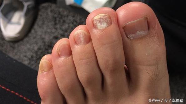 脚部出现这些问题可能是疾病先兆,脚不容忽视的健康信号