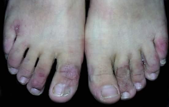 长过冻疮的手都会粗一圈，而且每年都会复发，7个小窍门杜绝复发