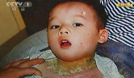 宝宝肤专家可以治疗湿疹吗,一岁半宝宝湿疹怎么治疗