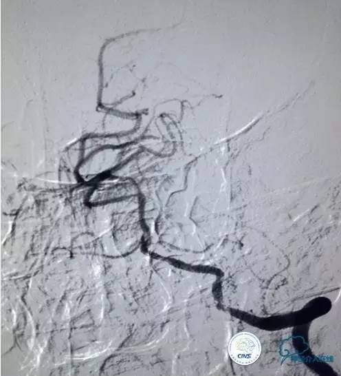 急性缺血性卒中静脉溶栓2018指南,急性缺血性卒中血管内再通标准