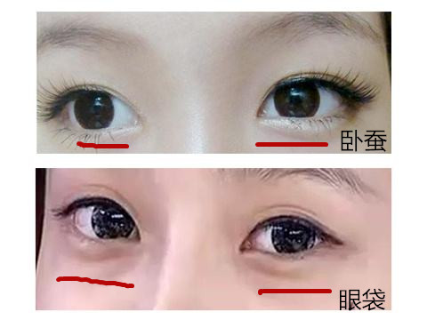 别把卧蚕当眼袋,卧蚕能去眼袋吗