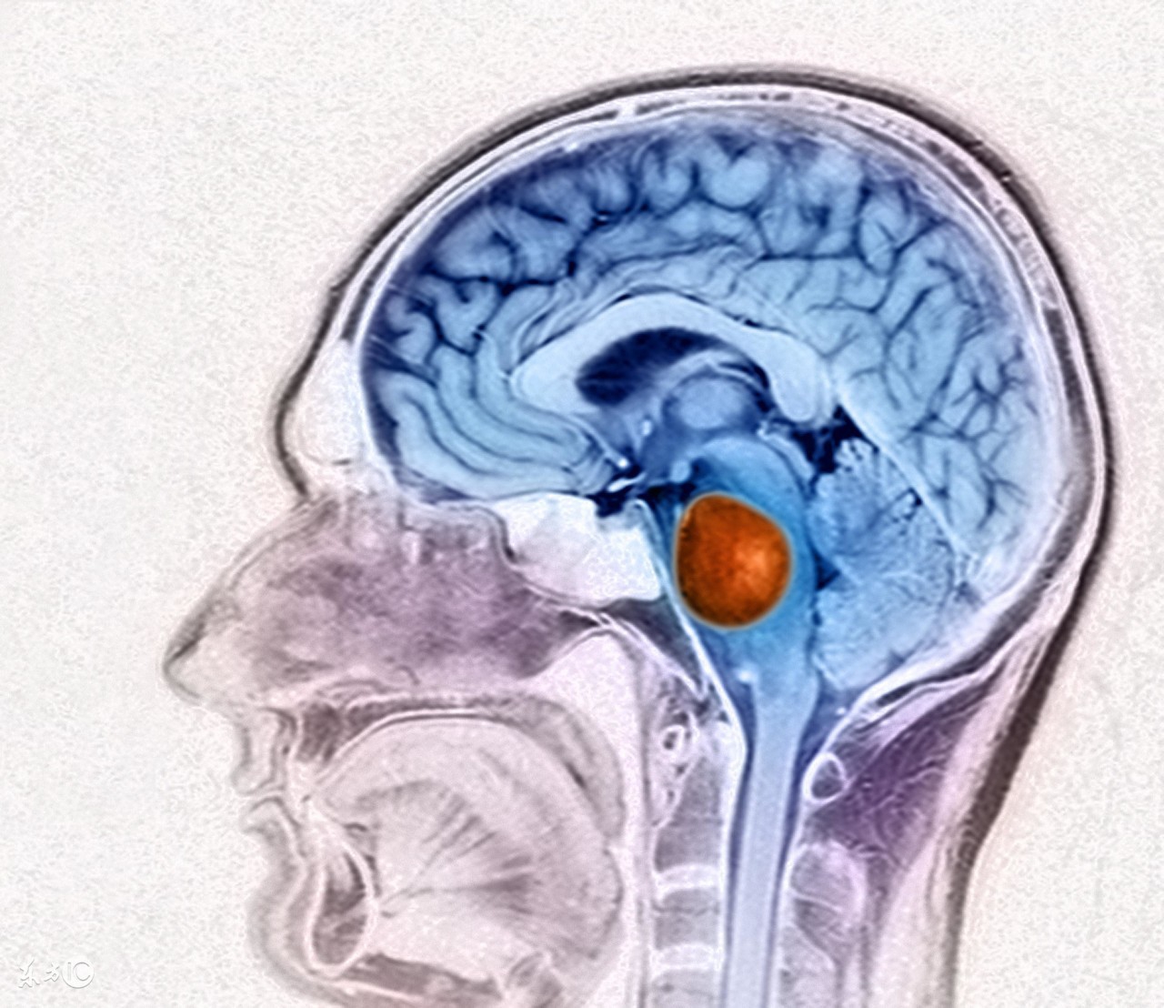 倪海厦讲脑瘤中医治疗方法,脑瘤中医治疗好还是西医好