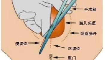 什么是侧切的演示,什么是侧切生孩子