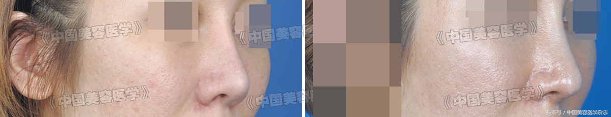 隆鼻做的越简单恢复的越快么,隆鼻十年了有点透光怎么修复