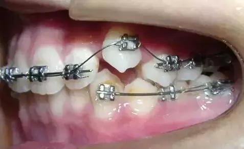 人为什么会少长牙,为什么会有虎牙齿