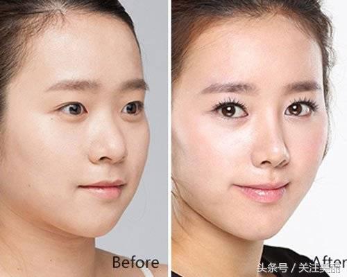 隆鼻后鼻子红肿怎么回事,隆鼻后鼻子肿胀是怎么回事