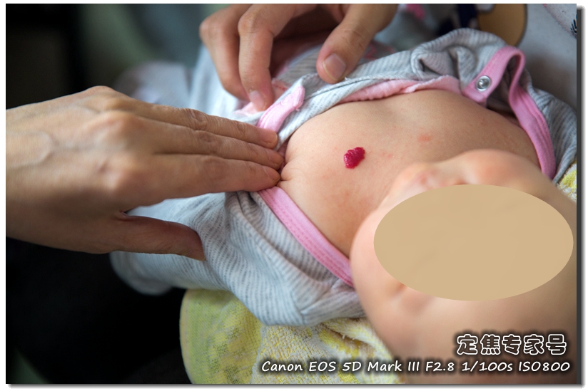 头皮有白色癣块去医院大概多少钱,治头皮问题的药一般多少钱