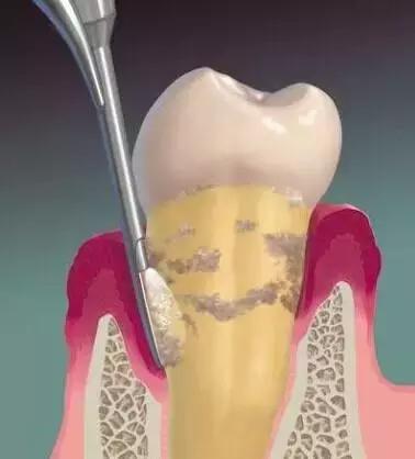 洗牙有什么副作用吗,洗牙怎么不伤牙