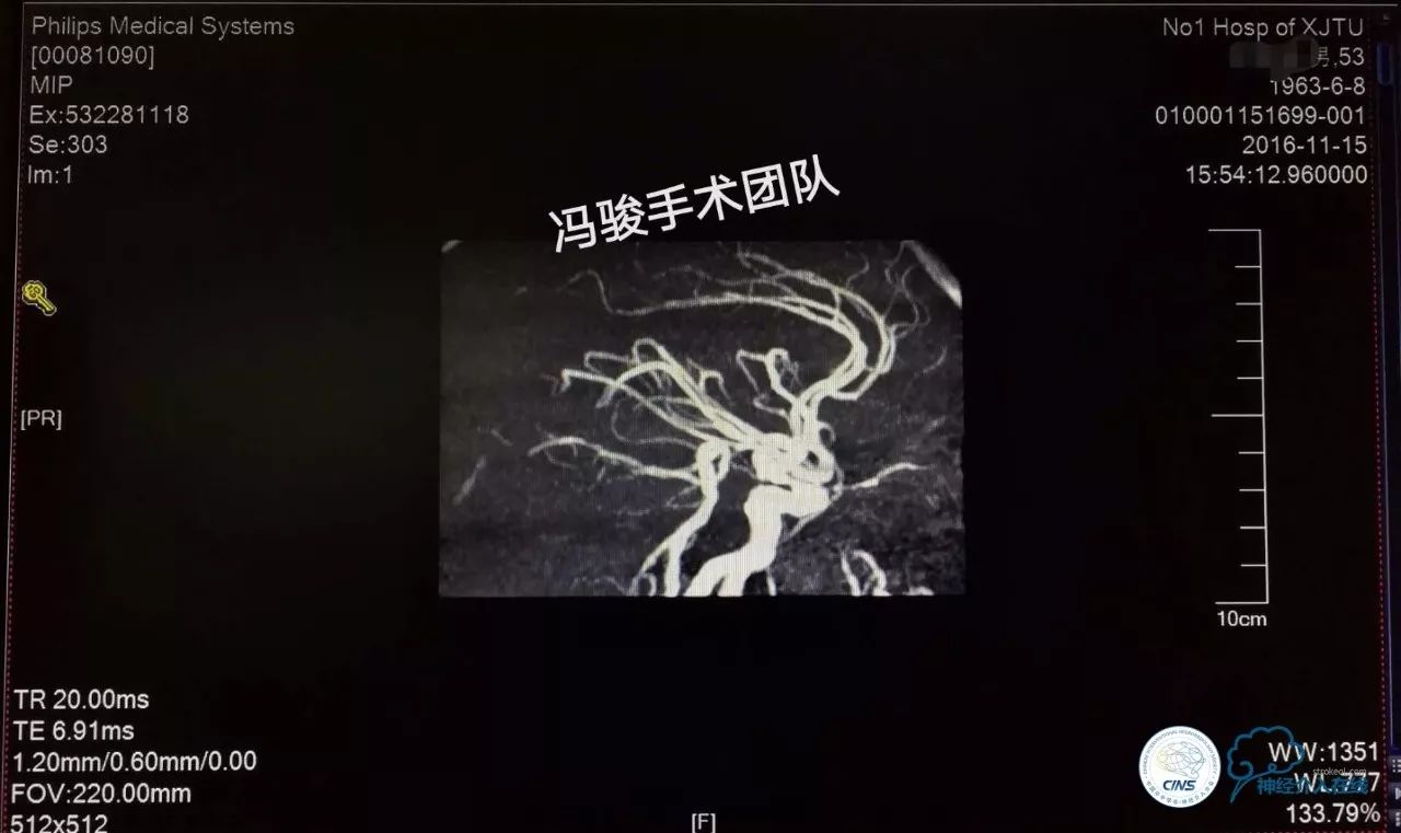 天新福—百家百言｜一例孤独椎动脉V4段并PICA重度狭窄支架手术及1年随访