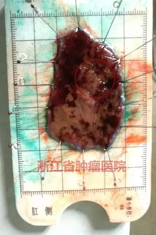 食管黏膜病变越大就一定是恶性吗,食管病变严重需要怎么治疗