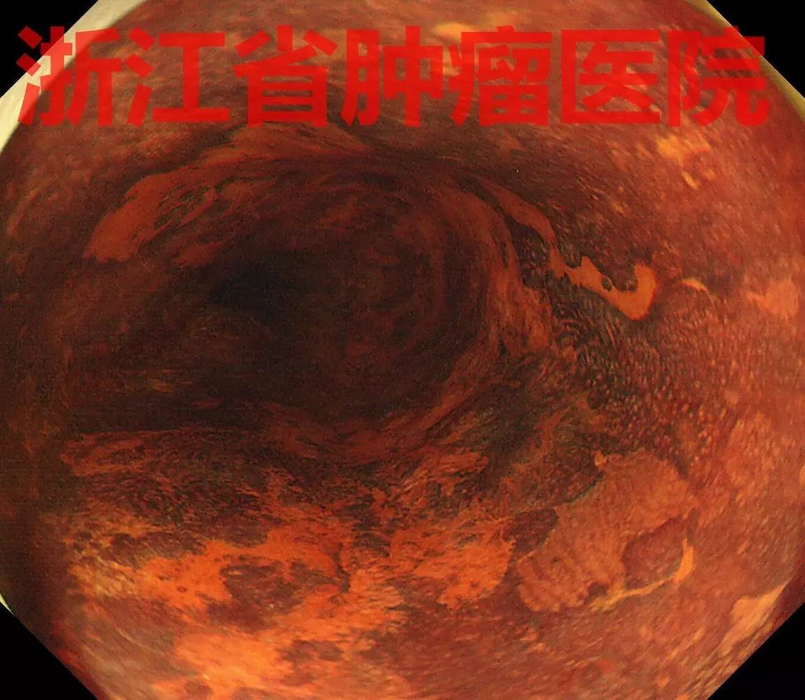 食管黏膜病变越大就一定是恶性吗,食管病变严重需要怎么治疗