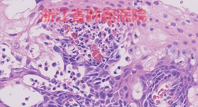 食管黏膜病变越大就一定是恶性吗,食管病变严重需要怎么治疗