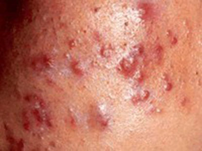 脸上起红疹是什么原因引起,脸上起红疹是什么原因引起的