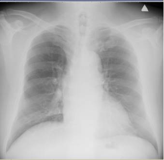 高血压病历的鉴别诊断,高血压合并症怎么检查