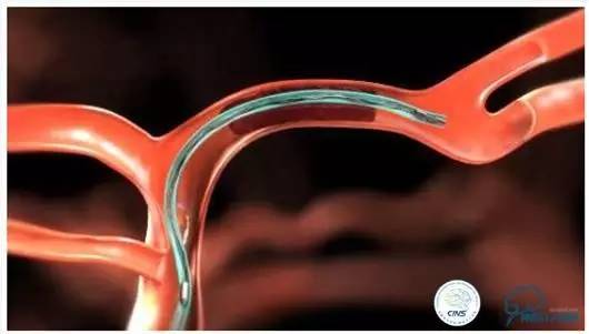 急性缺血性卒中静脉溶栓2018指南,急性缺血性卒中血管内再通标准