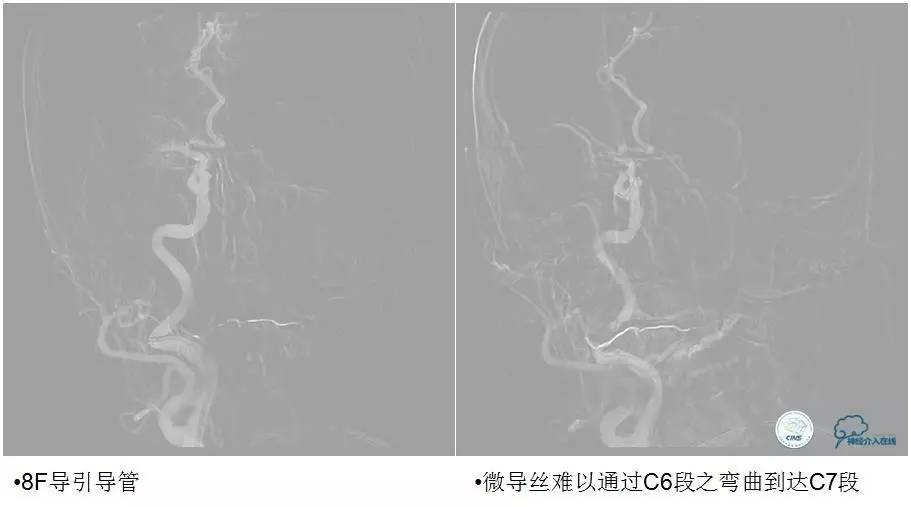 急性缺血性卒中静脉溶栓2018指南,急性缺血性卒中血管内再通标准